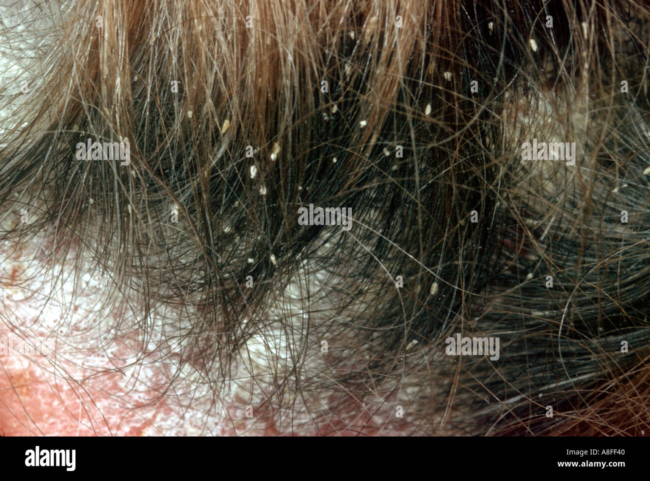 Psoriasis Sur Cuir Chevelu Photo Stock Alamy