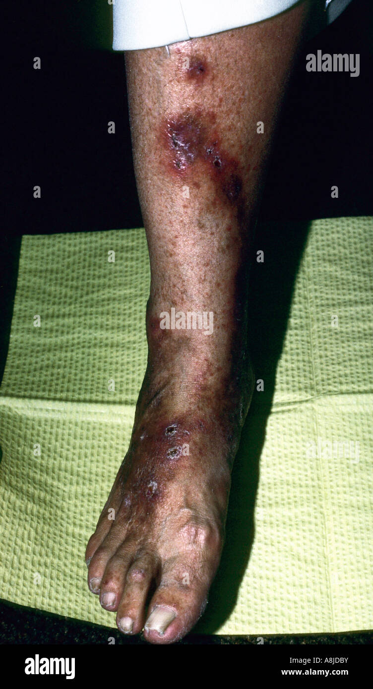 Patient avec l'eczéma Nummular sur sa jambe. Banque D'Images
