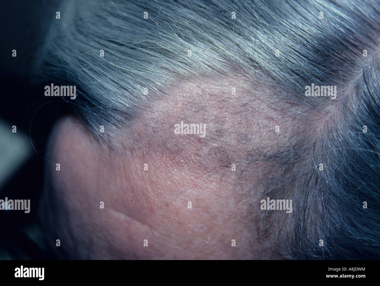 L'areata d'alopécie est une perte de cheveux. Banque D'Images