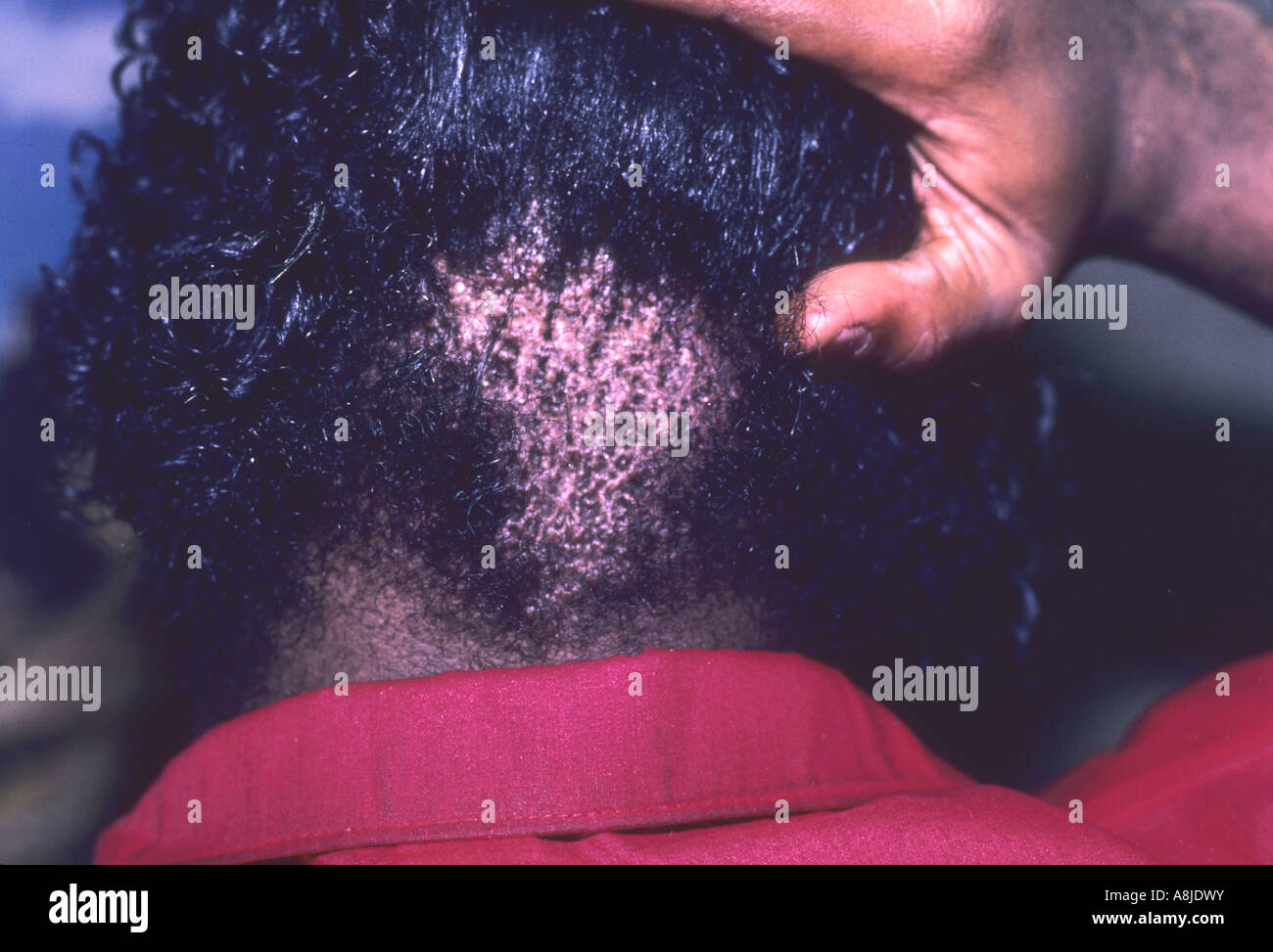 L'areata d'alopécie est une perte de cheveux. Banque D'Images