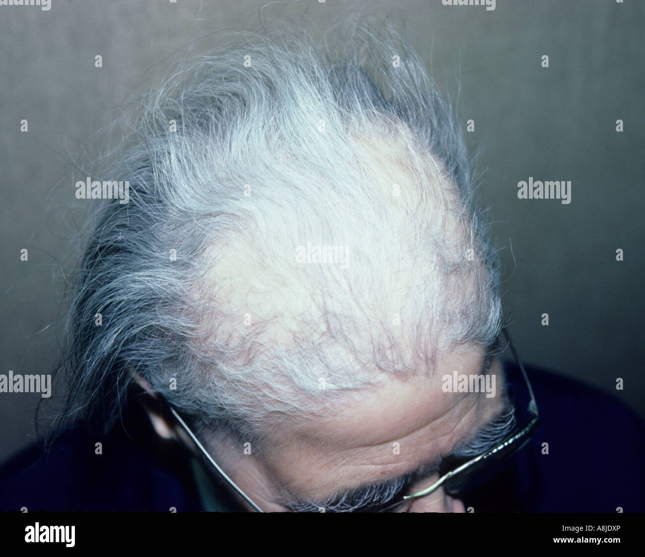 L'areata d'alopécie est une perte de cheveux. Banque D'Images