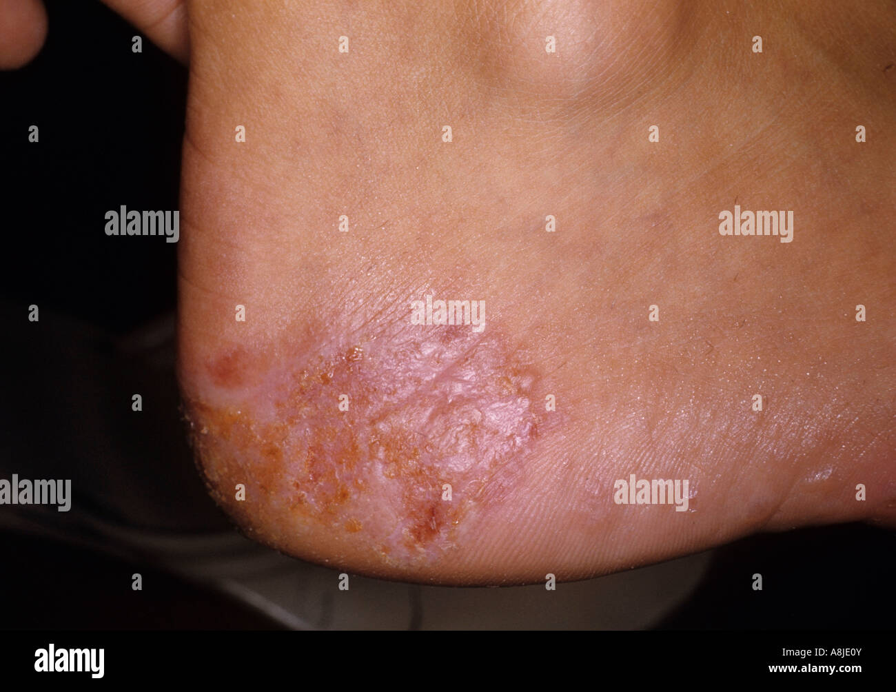 La dermatite de contact (eczéma) sur pied du patient et zone de guérison. Banque D'Images
