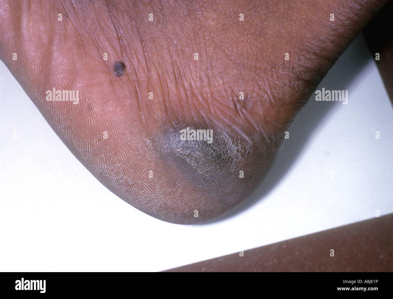 La dermatite de contact (eczéma) sur pied du patient et zone de guérison. Banque D'Images