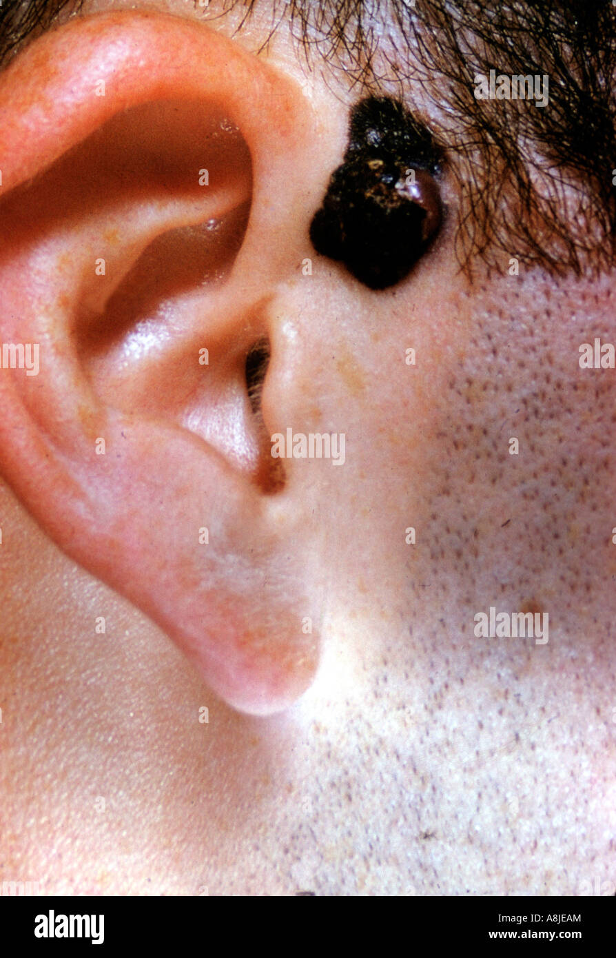 Cancer de l'oreille Banque de photographies et d'images à haute résolution  - Alamy