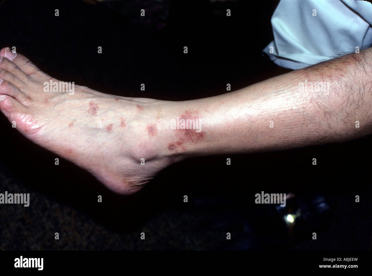 La dermatite eczéma de contact sur pied Banque D'Images
