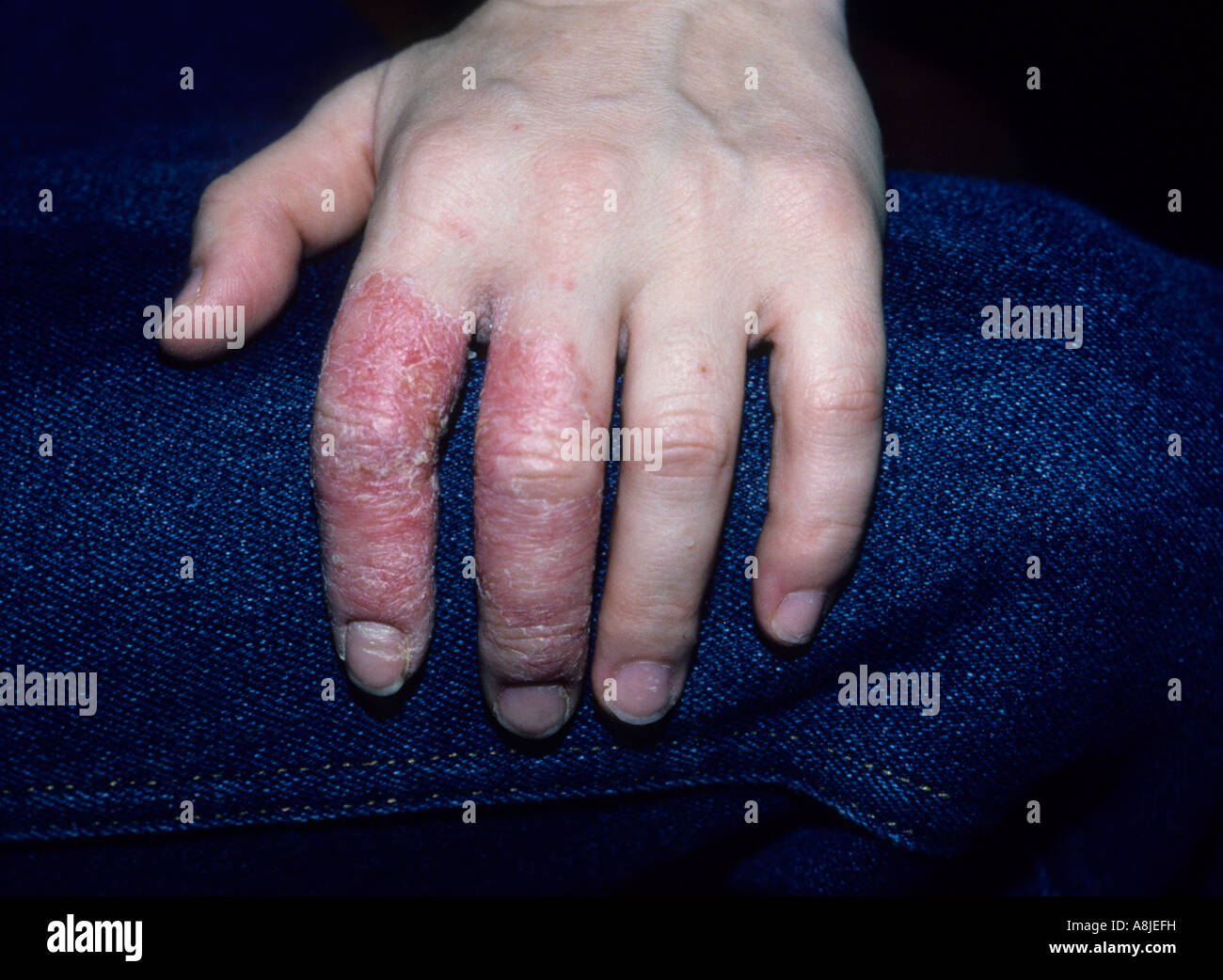 Nummular eczema Banque de photographies et d’images à haute résolution ...