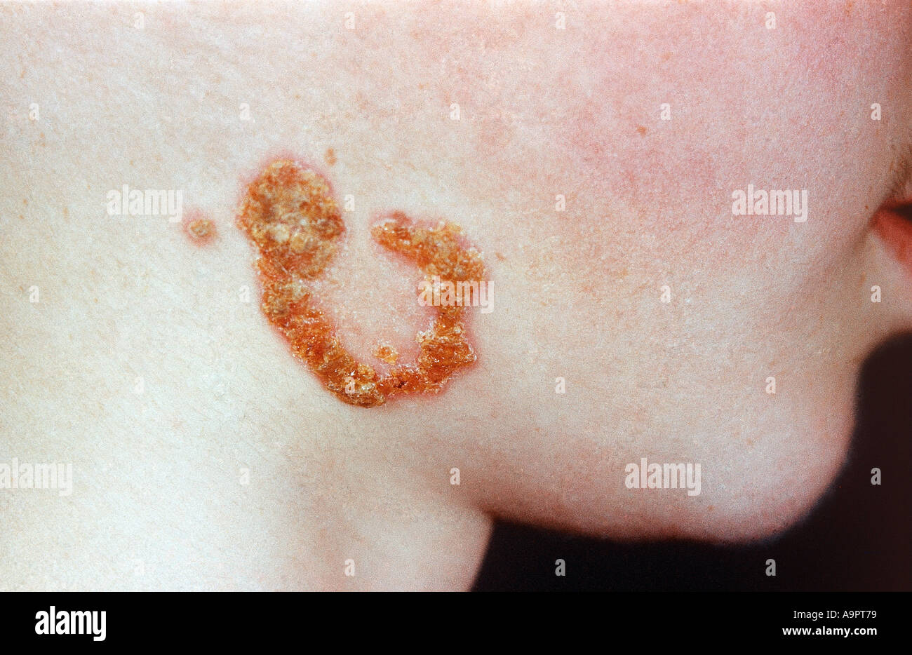 Impétigo Banque D'Images