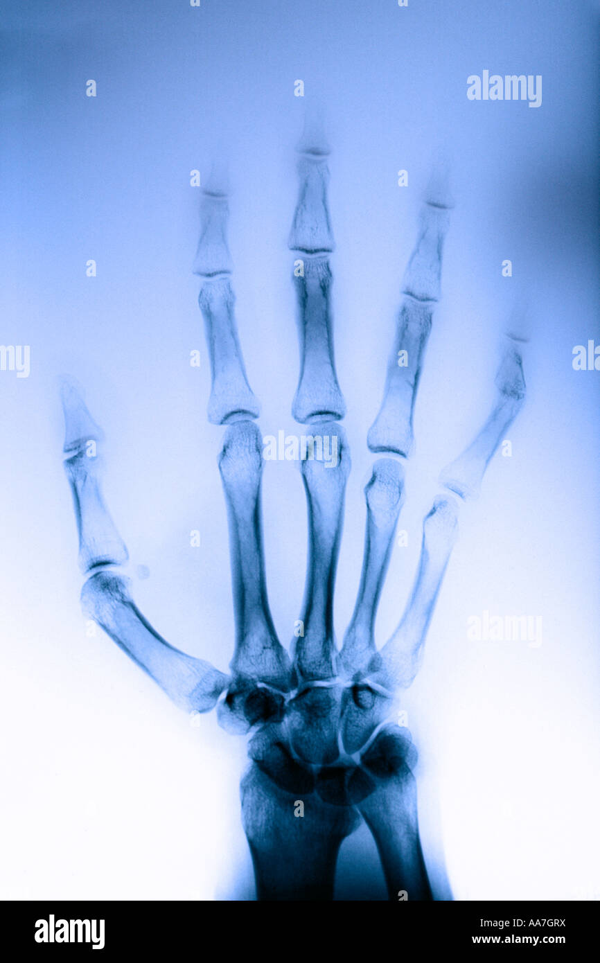 Rayons X de la main avec le doigt délogé. Imagerie médicale Banque D'Images