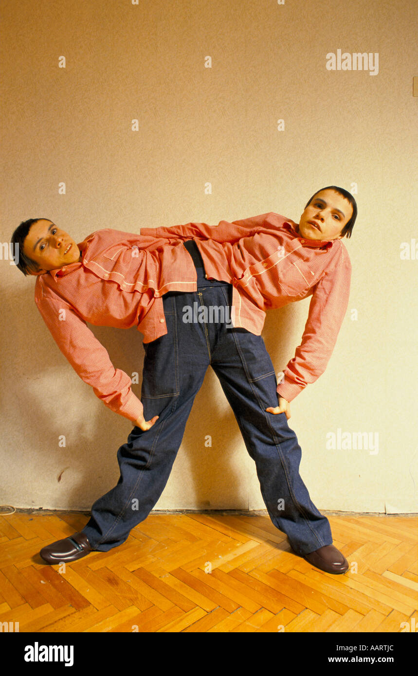 Jumeaux siamois russe masha et dasha krivoshlyapova à Moscou Banque D'Images