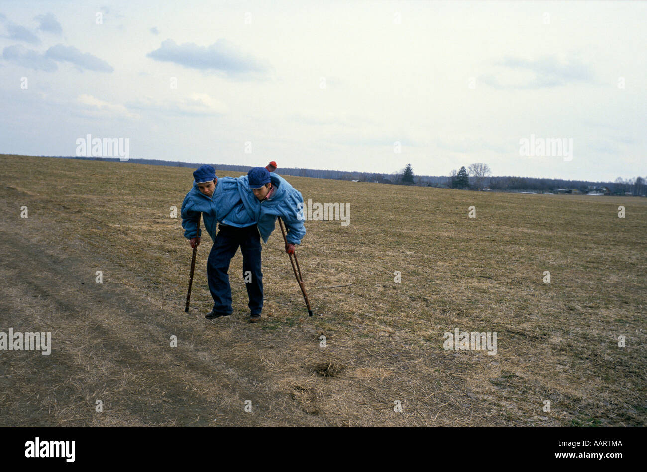Jumeaux siamois russe masha et dasha krivoshlyapova à Moscou Banque D'Images