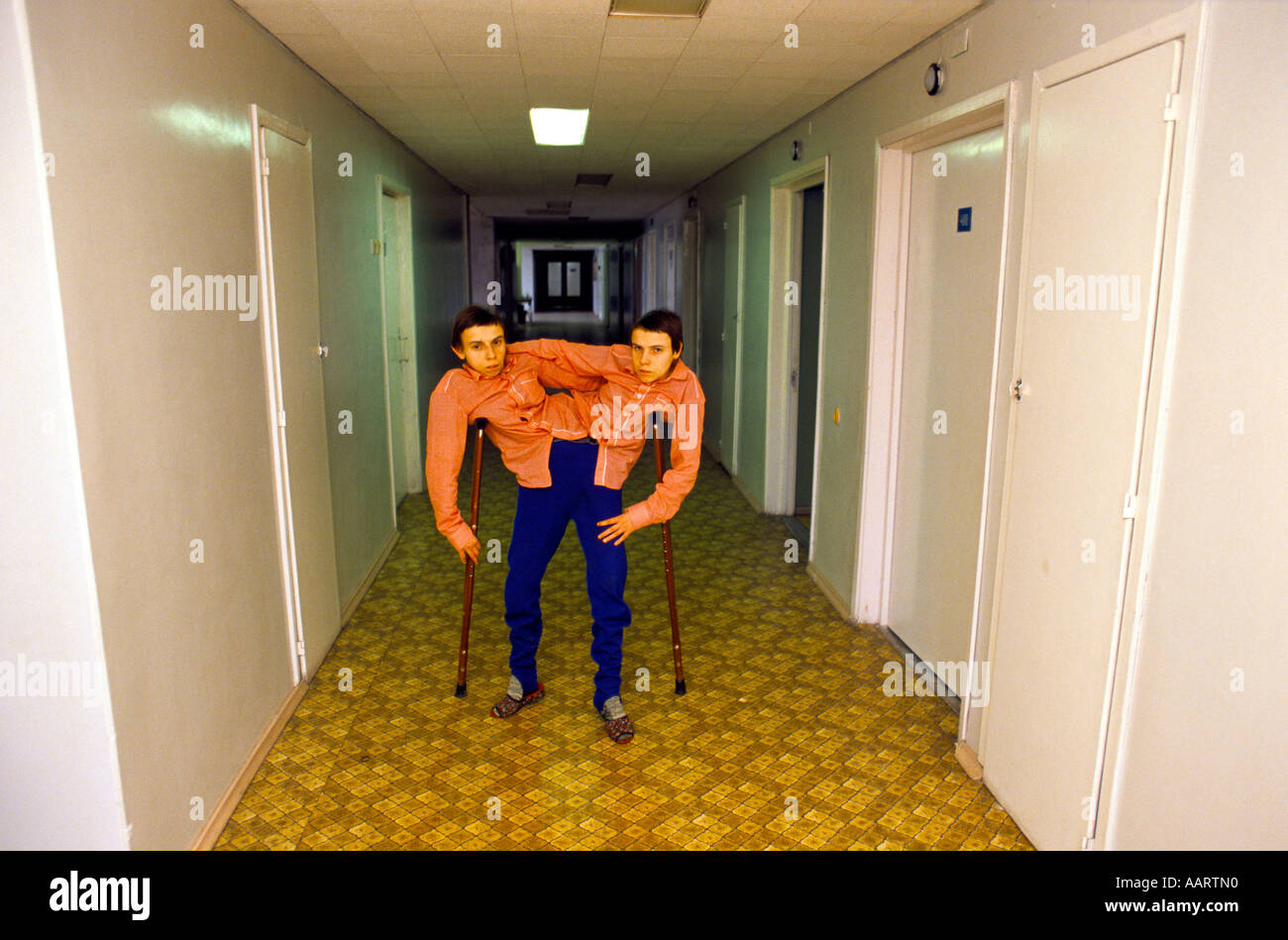 Jumeaux siamois russe masha et dasha krivoshlyapova à Moscou Banque D'Images