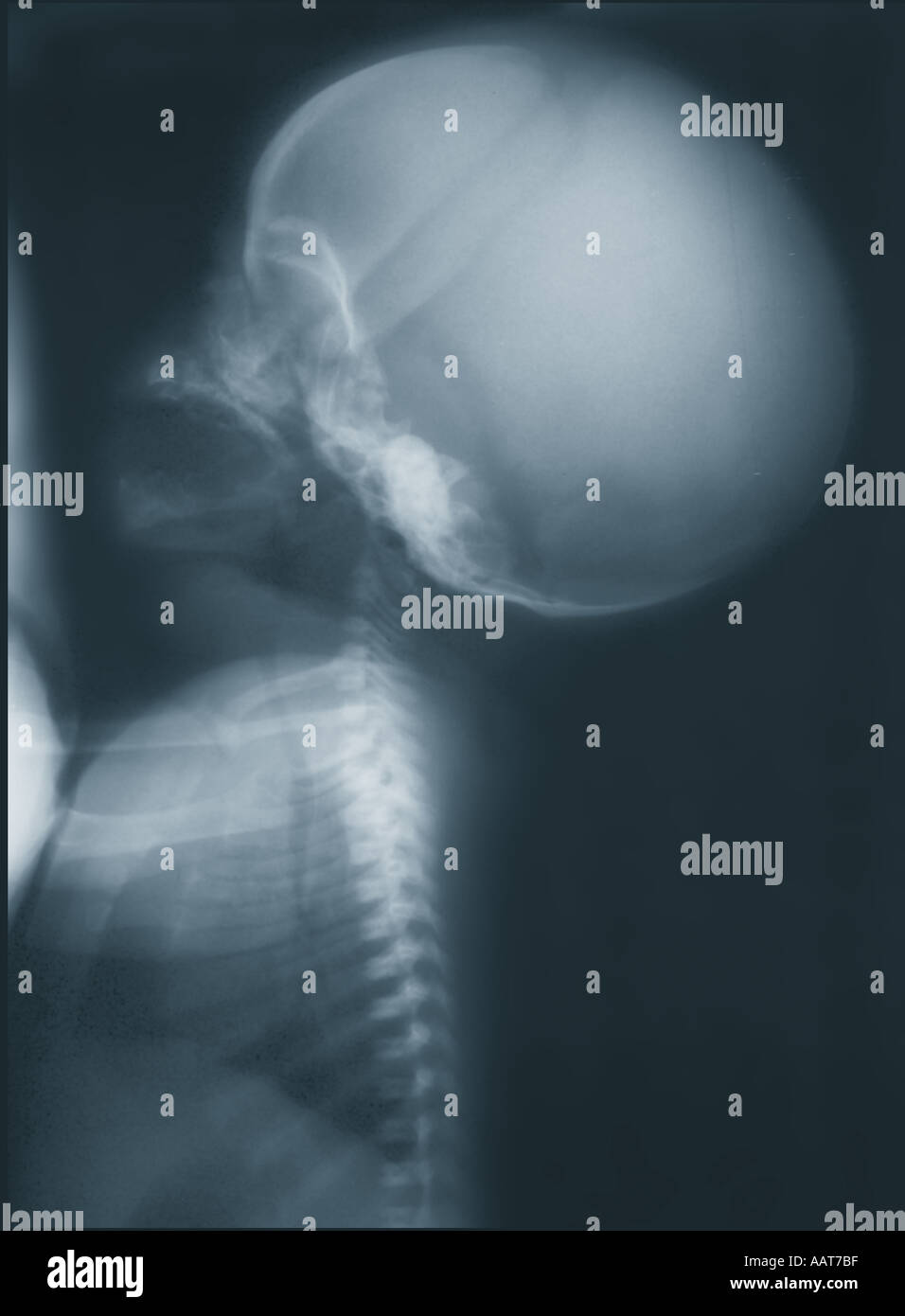 Achondroplasie Xray De Bebe Nouveau Ne Trouble Congenital Hereditaire D Chondroblastic Nanisme Causant La Croissance Epiphysaire Photo Stock Alamy