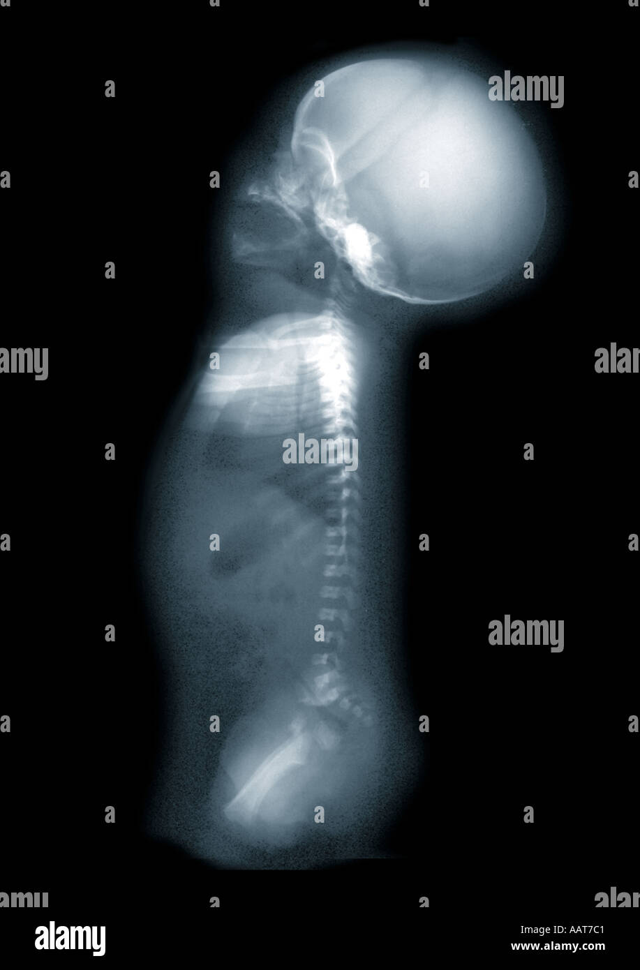 Achondroplasie Xray De Bebe Nouveau Ne Trouble Congenital Hereditaire D Chondroblastic Nanisme Causant La Croissance Epiphysaire Photo Stock Alamy Achondroplasie Xray De Bebe Nouveau Ne Trouble Congenital Hereditaire D Chondroblastic Nanisme Causant La Croissance Epiphysaire Photo Stock Alamy