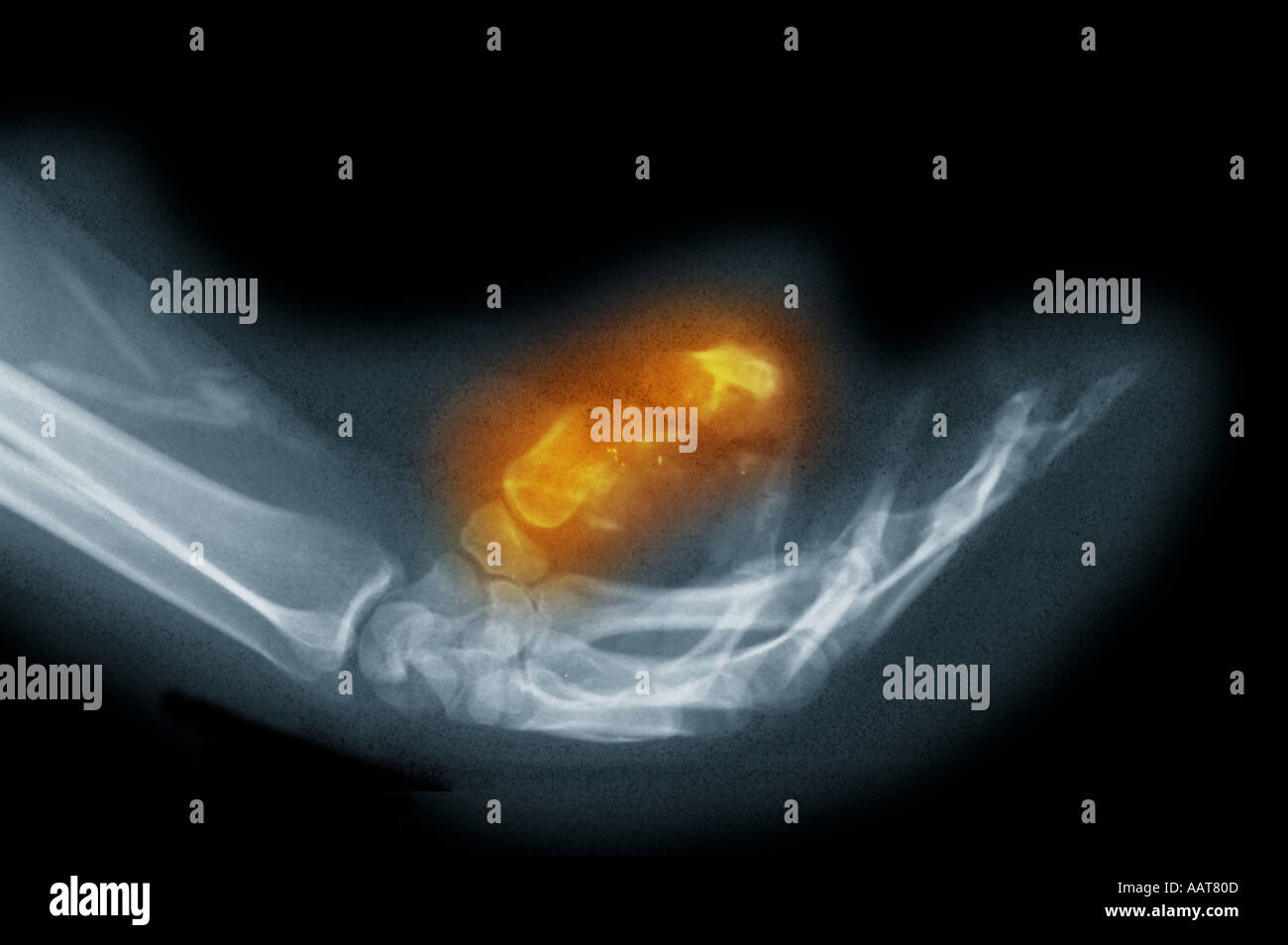 Xray de balle à la main avec amputation partielle du pouce Banque D'Images