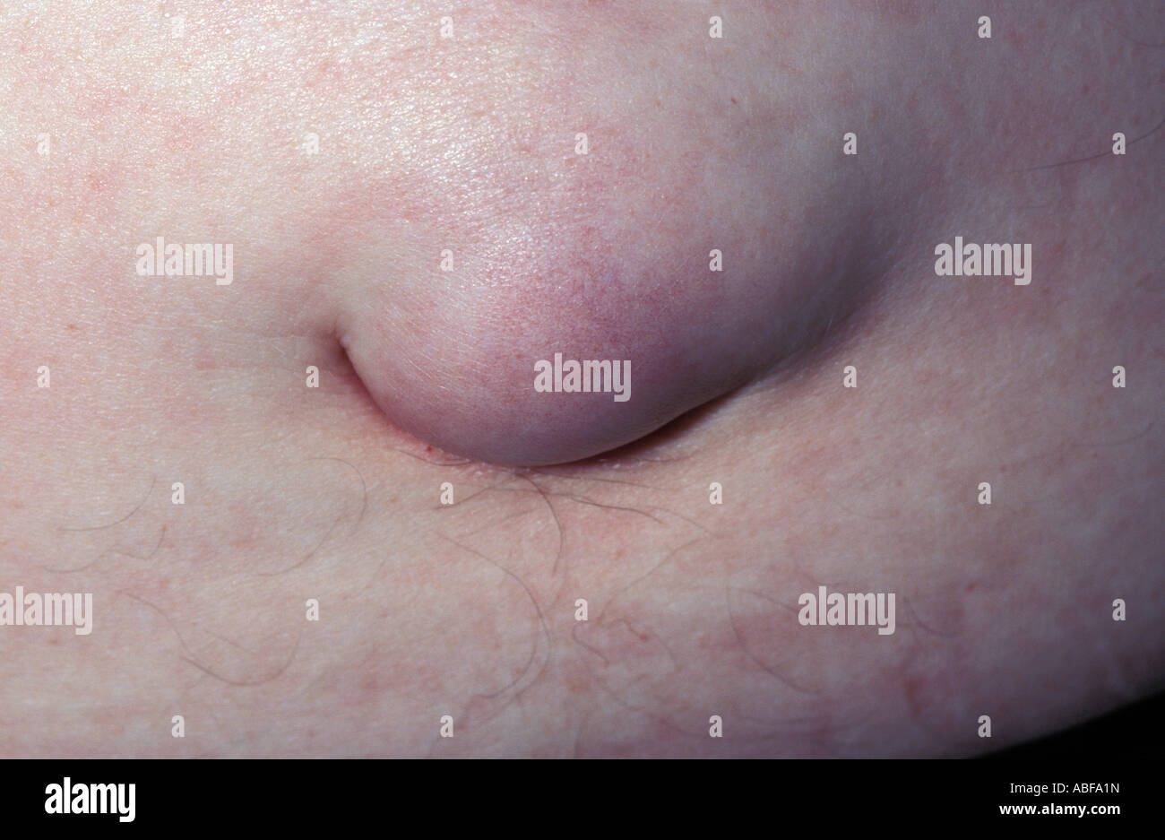 Hernie Ombilicale Banque D Image Et Photos Alamy