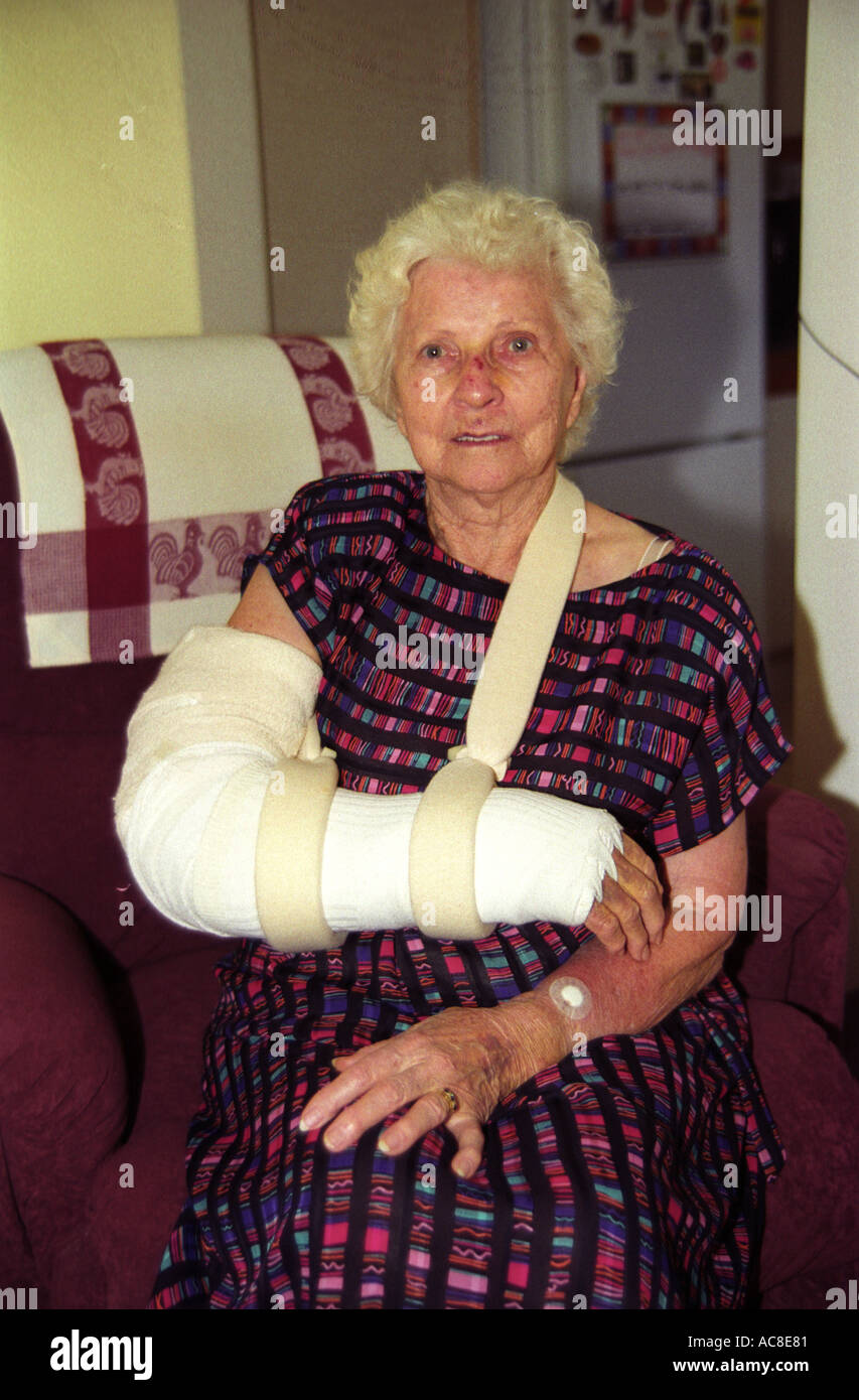 Femme plus âgée avec visage meurtri après une chute en stationnement bras cassé dans le plâtre moulé 1549 Banque D'Images