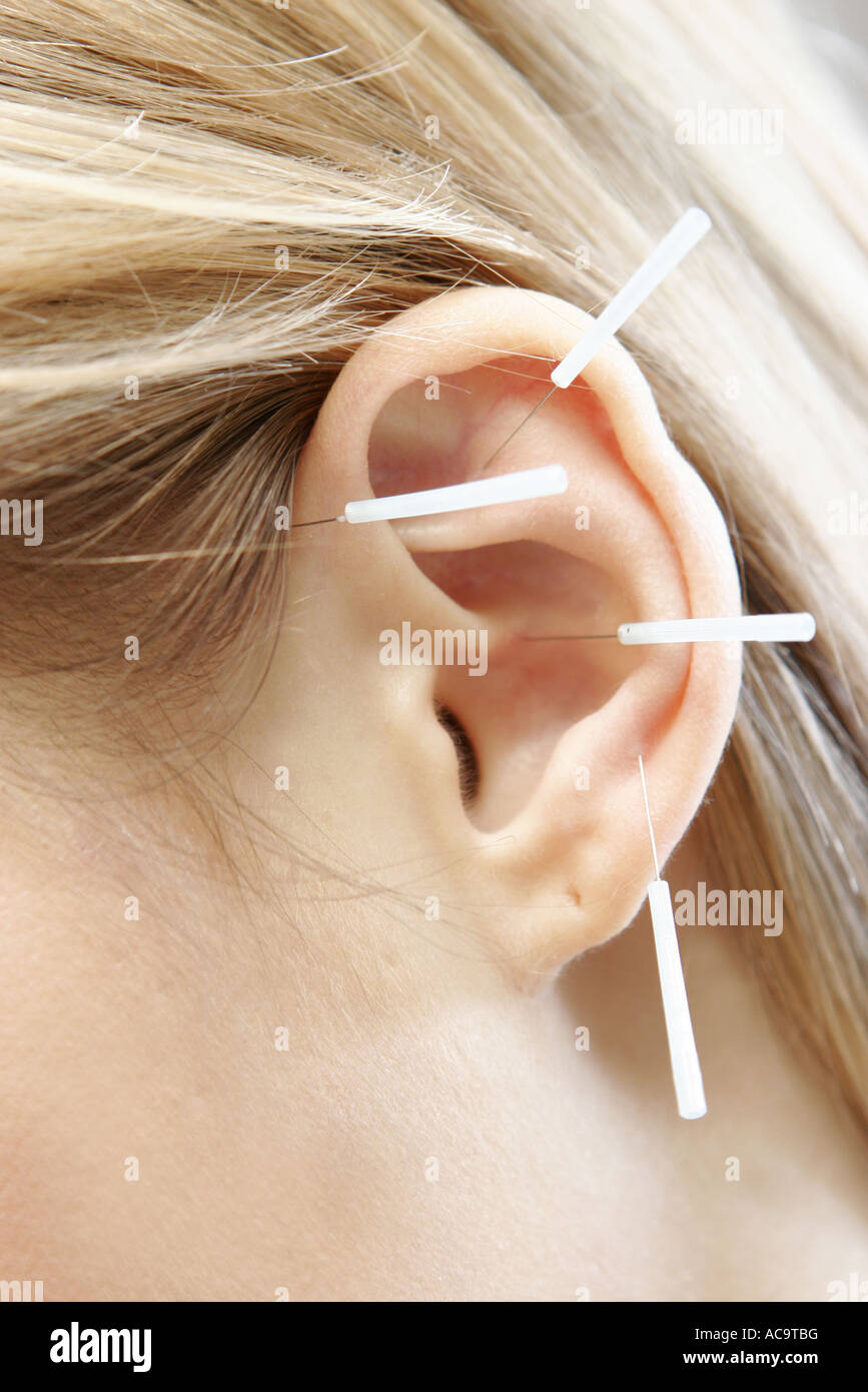 Les aiguilles d'Acupuncture dans l'oreille Photo Stock - Alamy