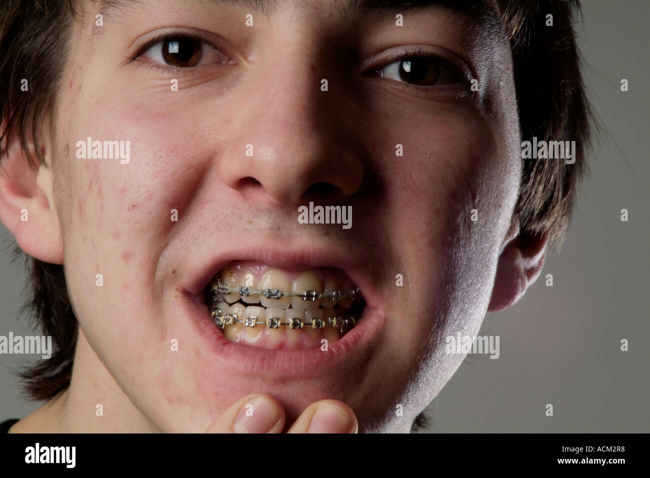 Teenage boy se séparer ses lèvres pour montrer les accolades orthodontique fixe sur ses dents Banque D'Images