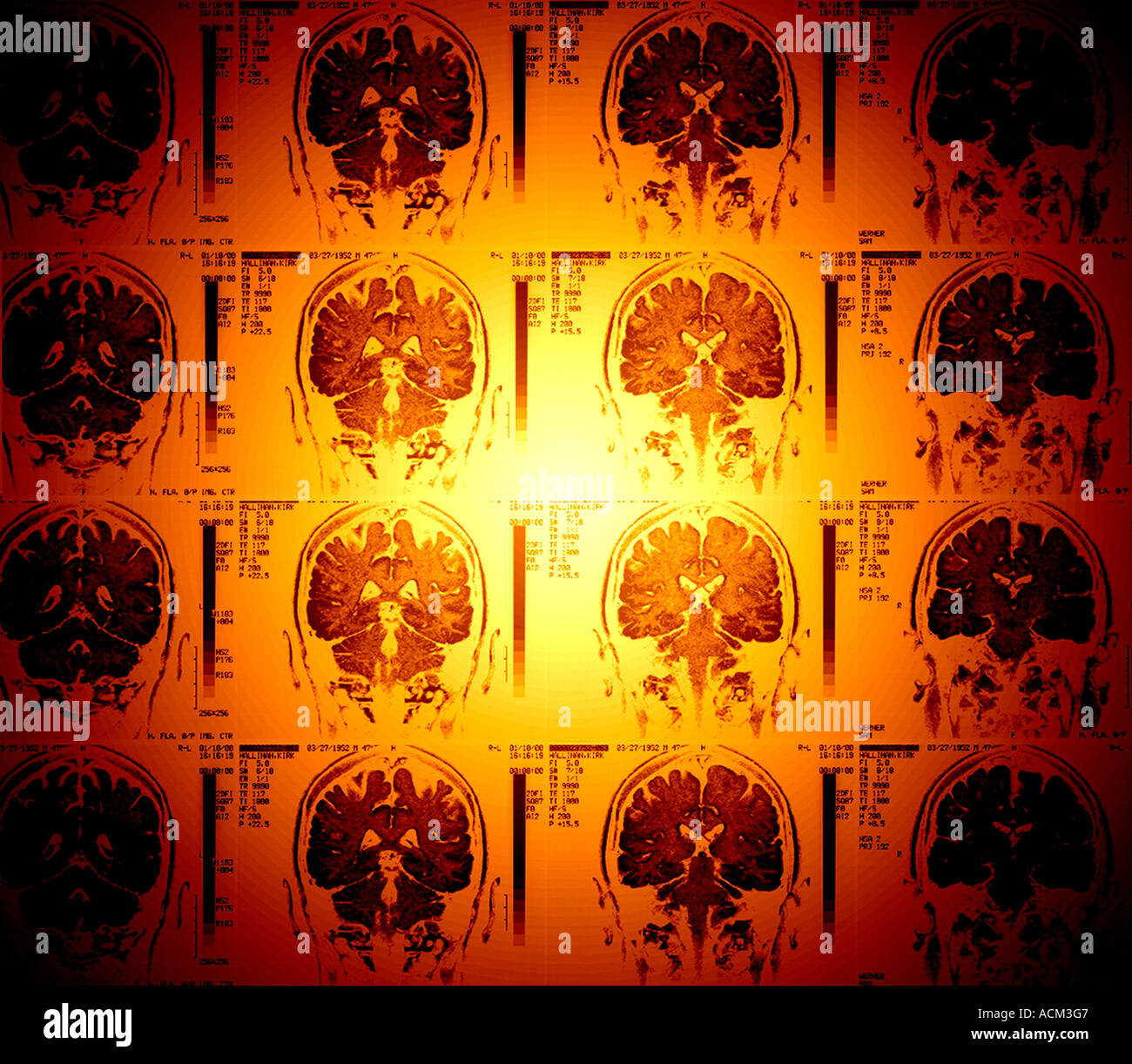 Les rayons colorés de cortex cérébral cervelet IRM du cerveau humain Banque D'Images
