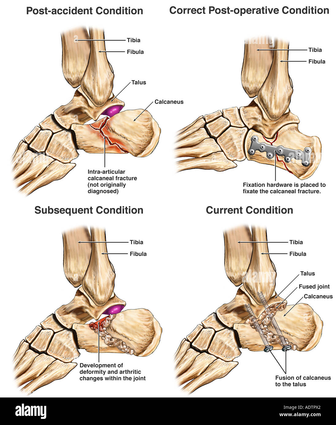 Calcaneus fracture Banque de photographies et d’images à haute