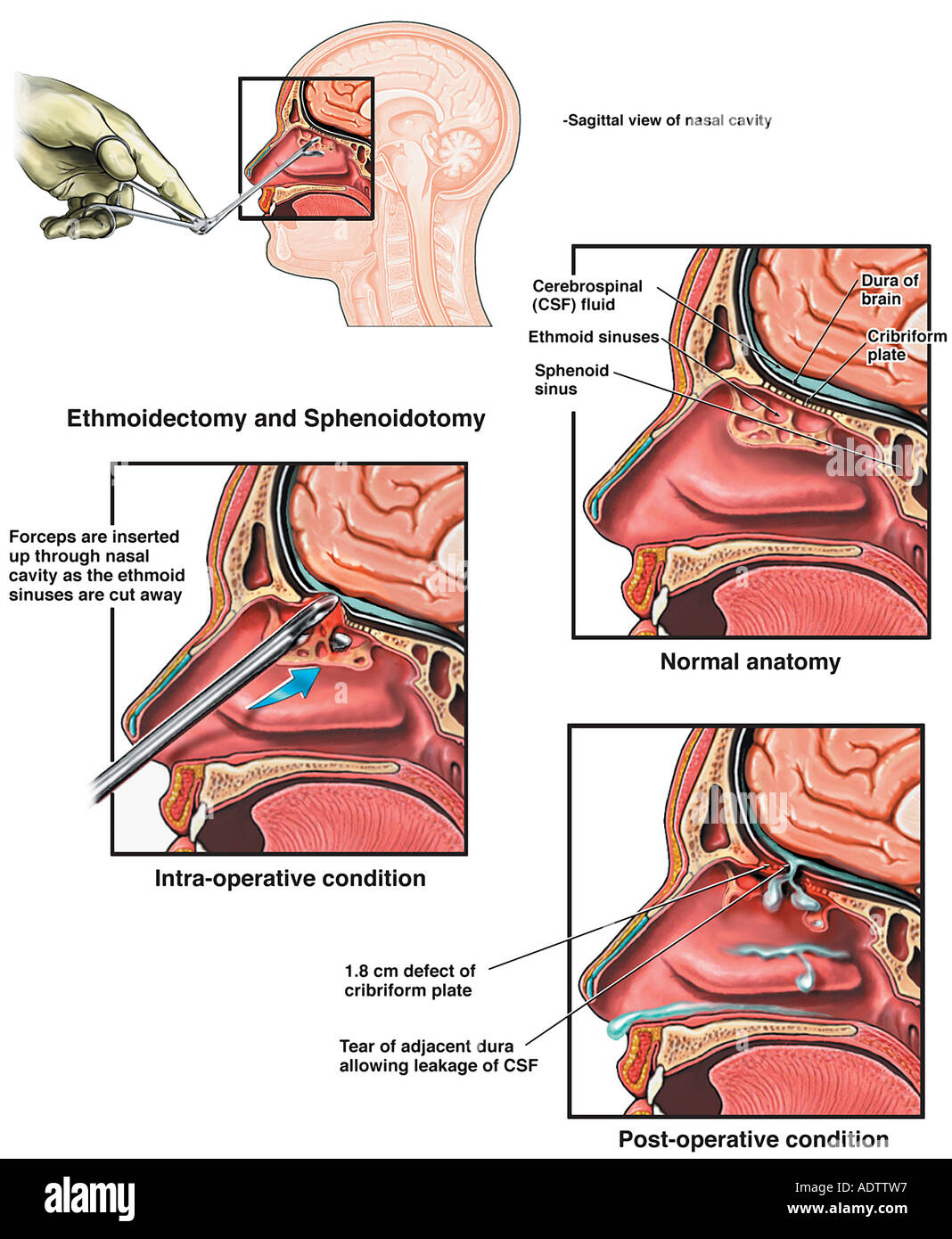 La chirurgie endoscopique des sinus avec des dommages qui en résultent