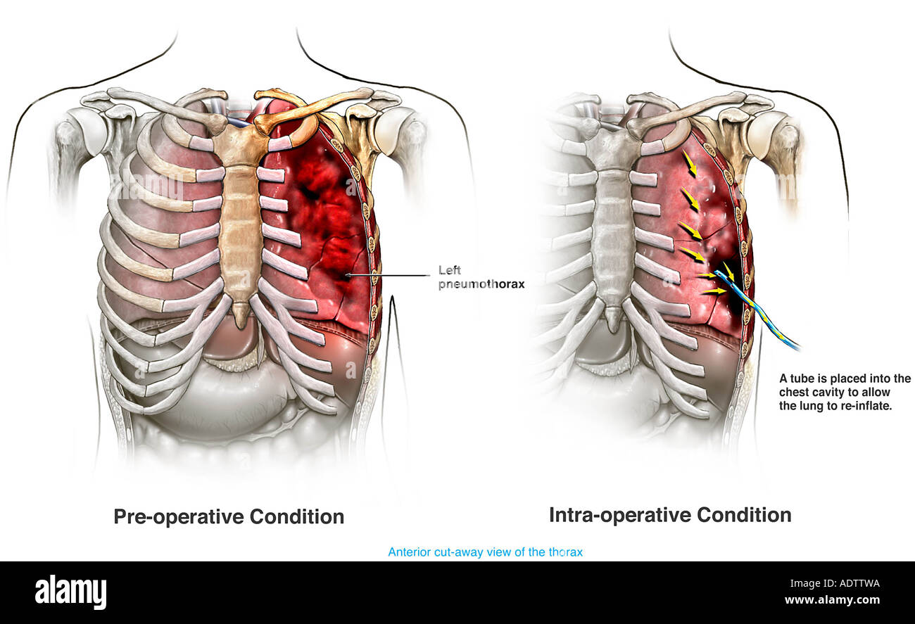 Pneumothorax avec Placement d'un drain thoracique pour regonfler les poumons Banque D'Images