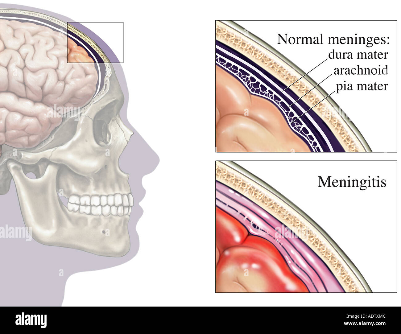 Bacterial meningitis Banque de photographies et d’images à haute ...