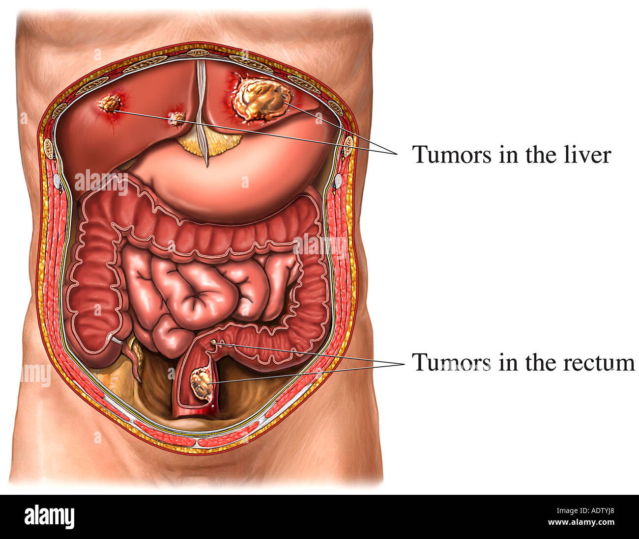 Le cancer du côlon avec métastases au foie Photo Stock - Alamy