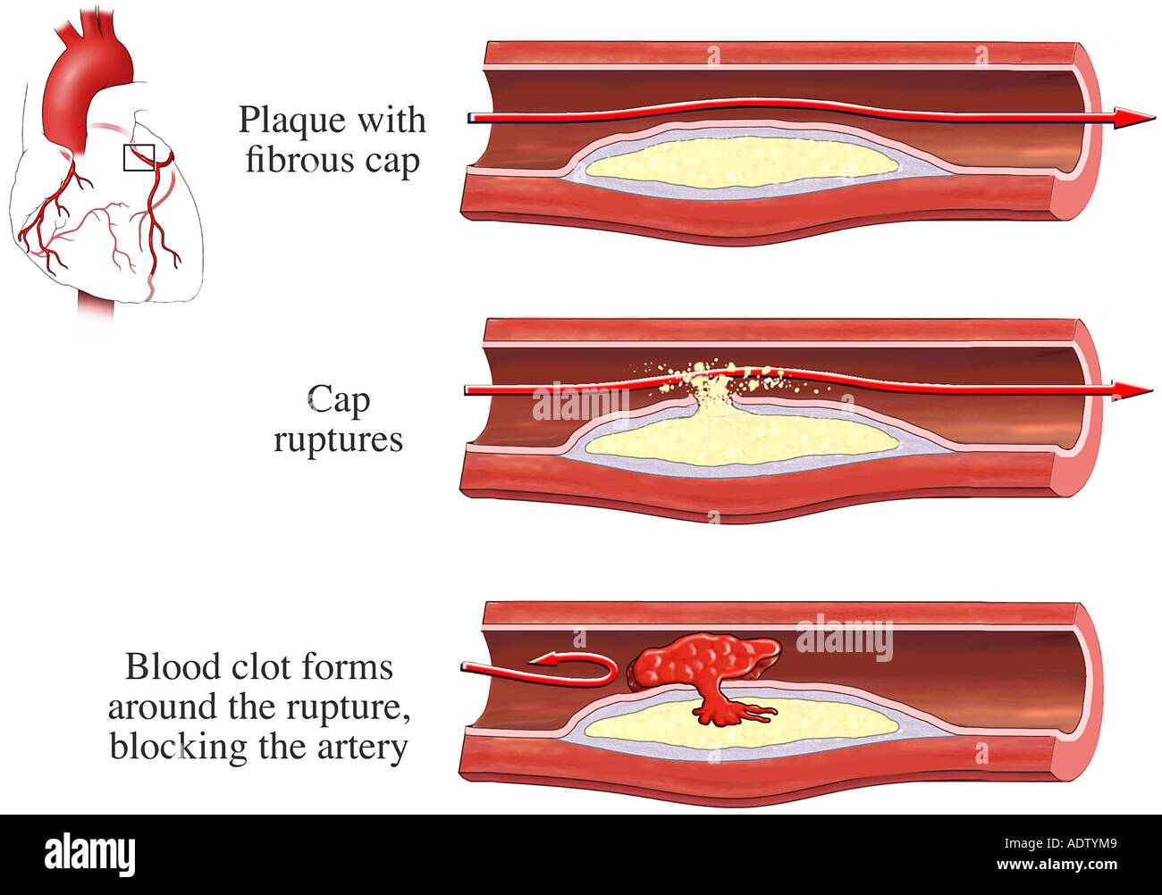 Arterial Rupture Banque d'image et photos Alamy