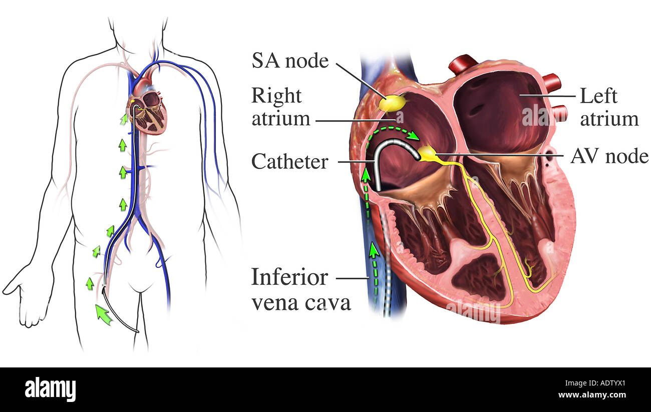 Cathétérisme Coronaire Banque d'image et photos Alamy
