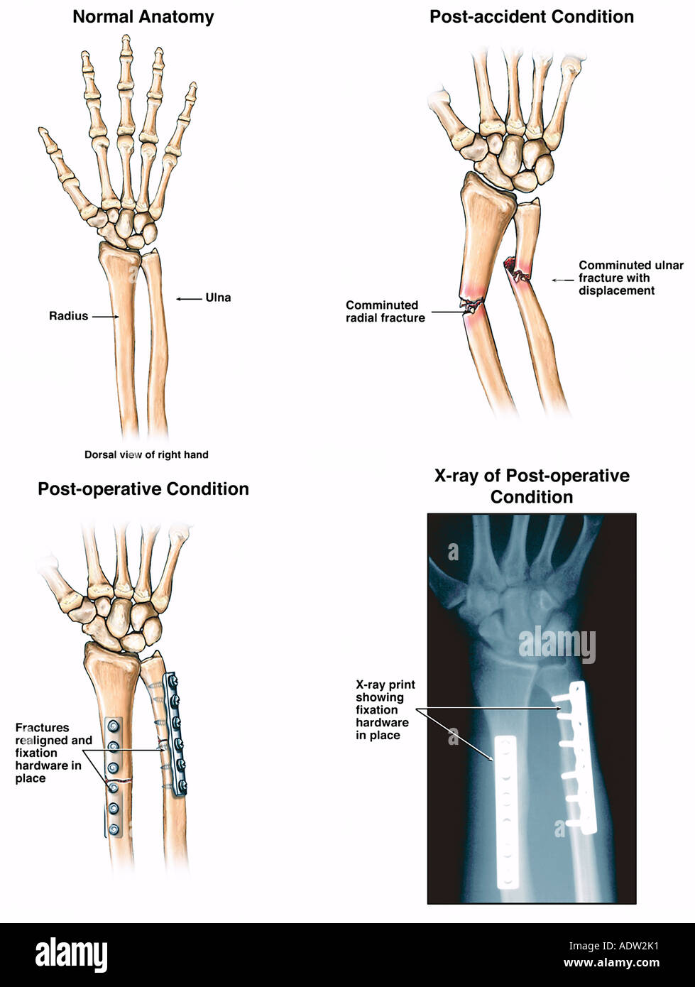 Les fractures du bras après un accident avec fixation chirurgicale