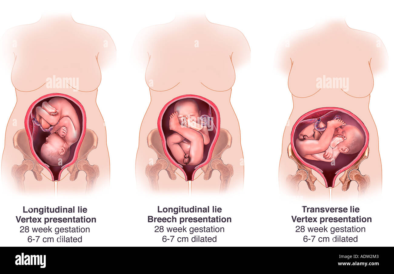 Fetus Presentation Banque D Image Et Photos Alamy Fetus Presentation Banque D Image Et Photos Alamy