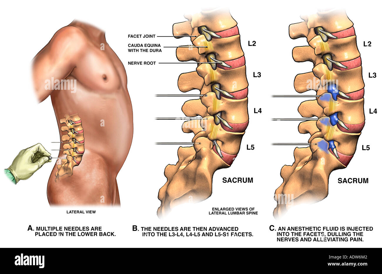 La gestion de la douleur au bas du dos du nerf articulaire lombaire Photo  Stock - Alamy