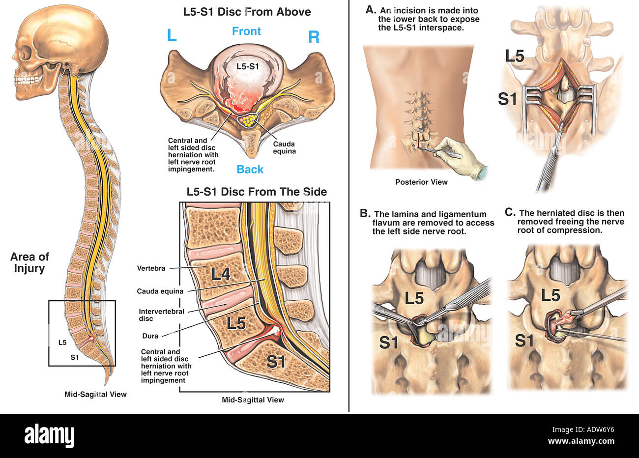 Дерматом хамби. Дерматом l5 s1. Вертеброгенная люмбалгия. Радикулит поясничный симптомы. Диски позвоночника l3-4, l5-s1.