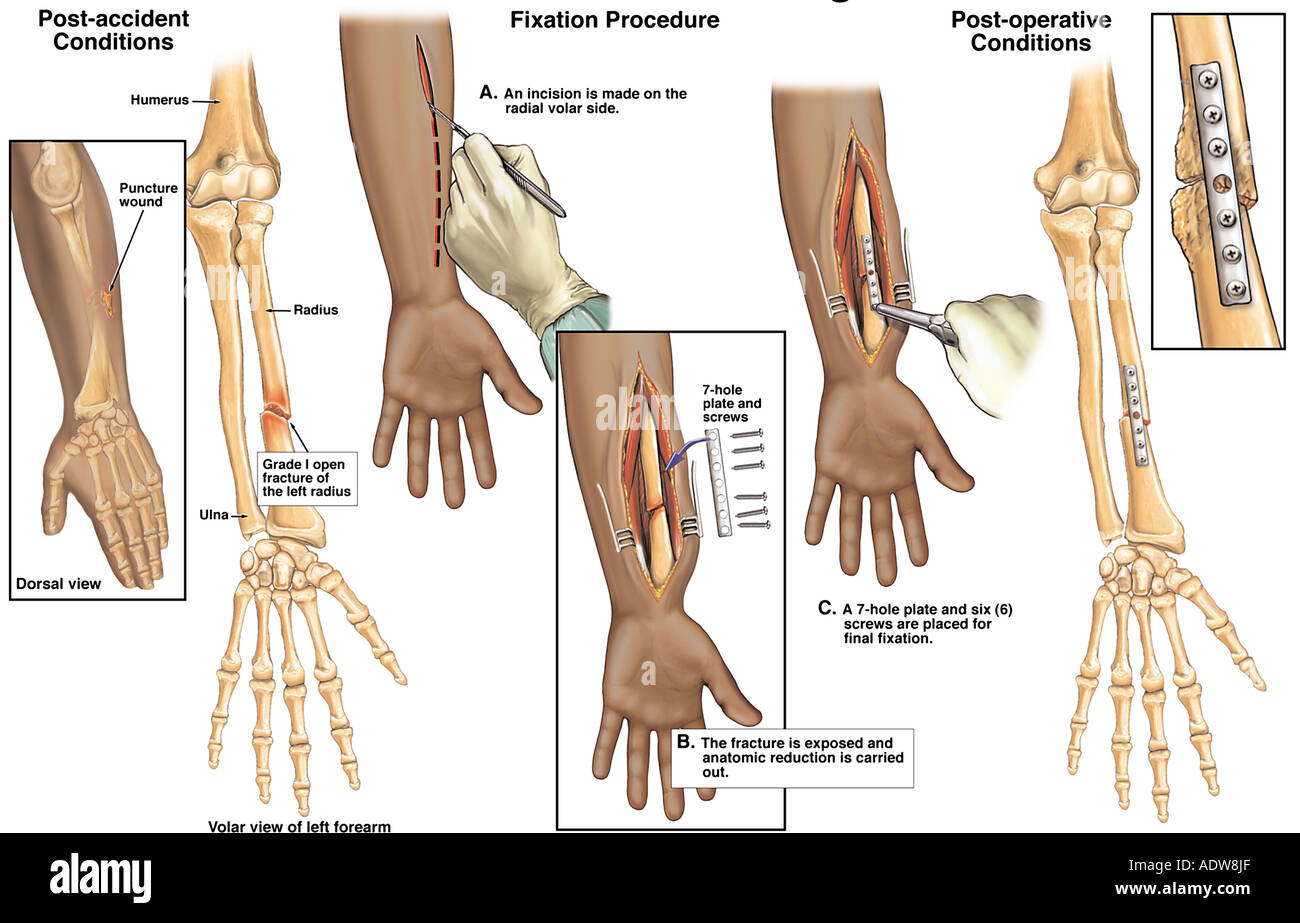 Fracture de l'avantbras gauche avec fixation chirurgicale Photo Stock