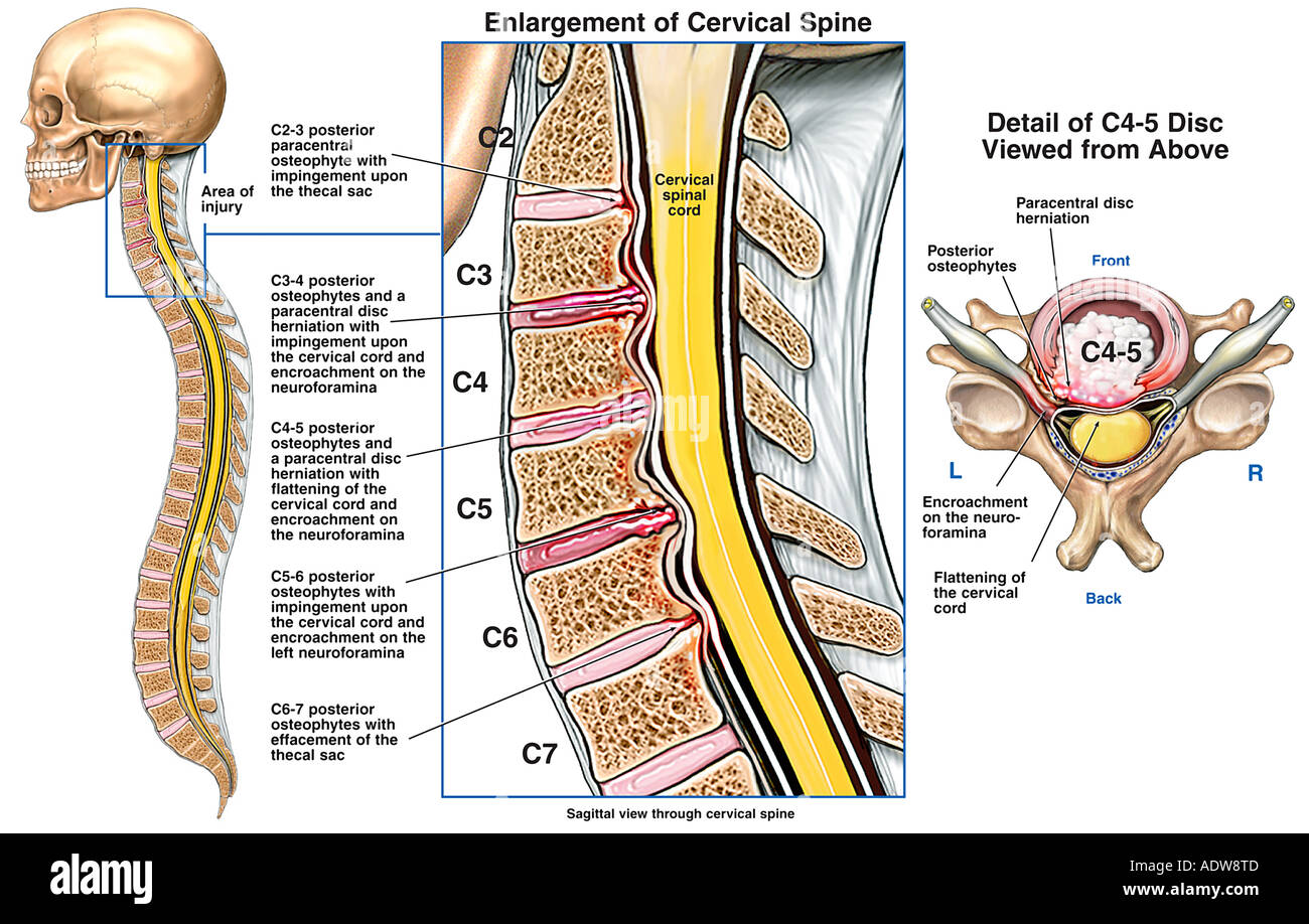 Spinal Cord C3 C4 : What Does Spinal Cord Compression Feel Like? – CPSIM