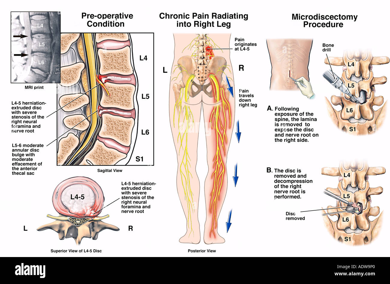 Иннервация грыжи l5-s1. Куда отдает грыжа. Колено l5 дерматом. Схема иннервации позвоночника в поясничном отделе. Грыжа поясничного отдела симптомы.