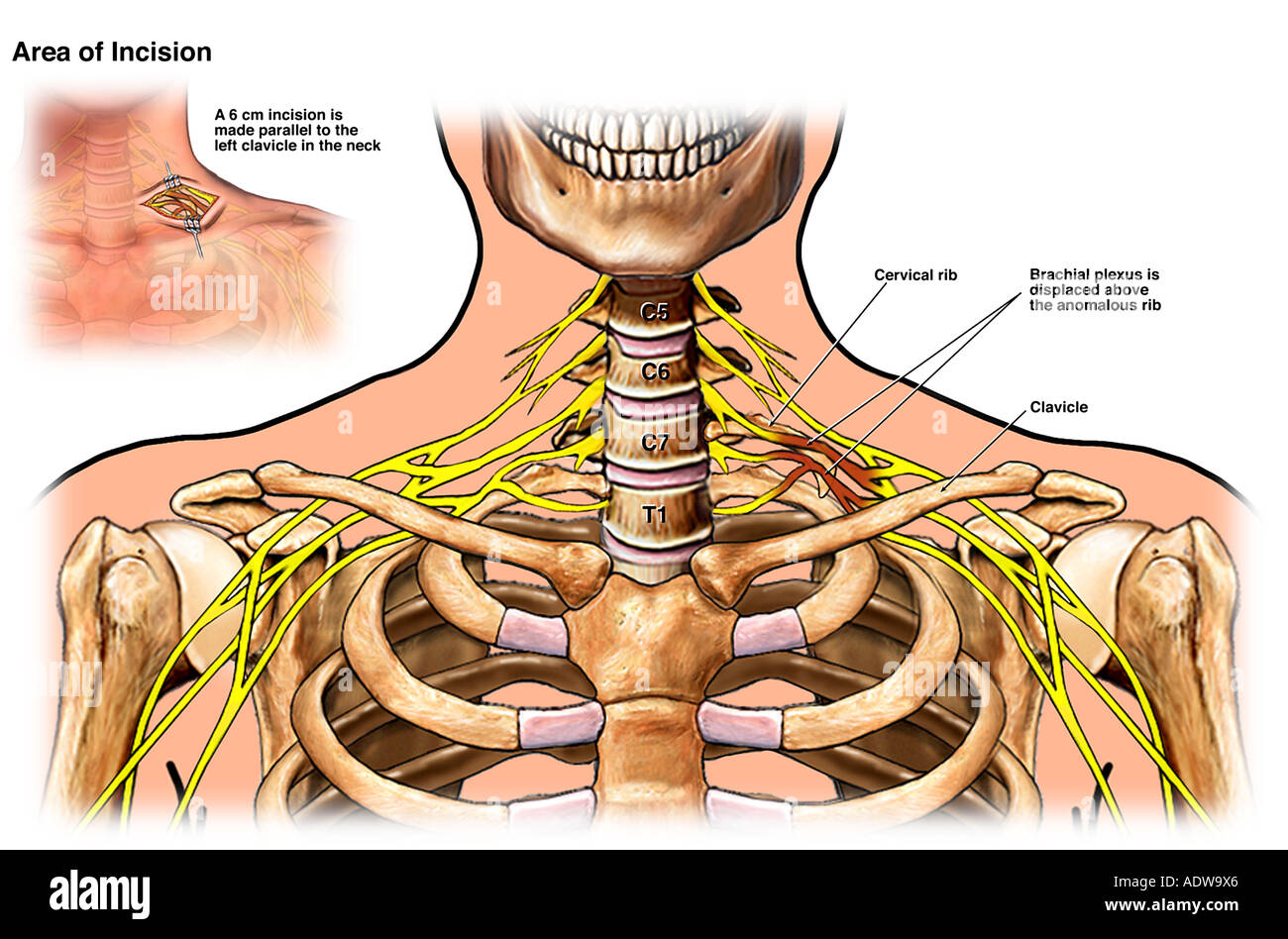 Plexus Brachial Banque d'image et photos - Alamy