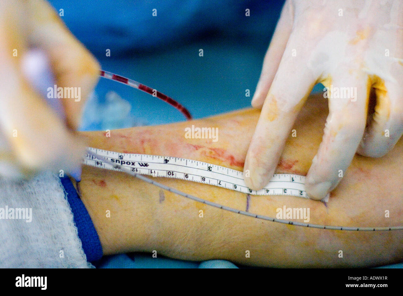 Mesures de médecin, le long de la jambe du patient pour évaluer la distance et la vitesse pour la dépose de la fibre laser utilisé dans l'ablation de la veine Banque D'Images