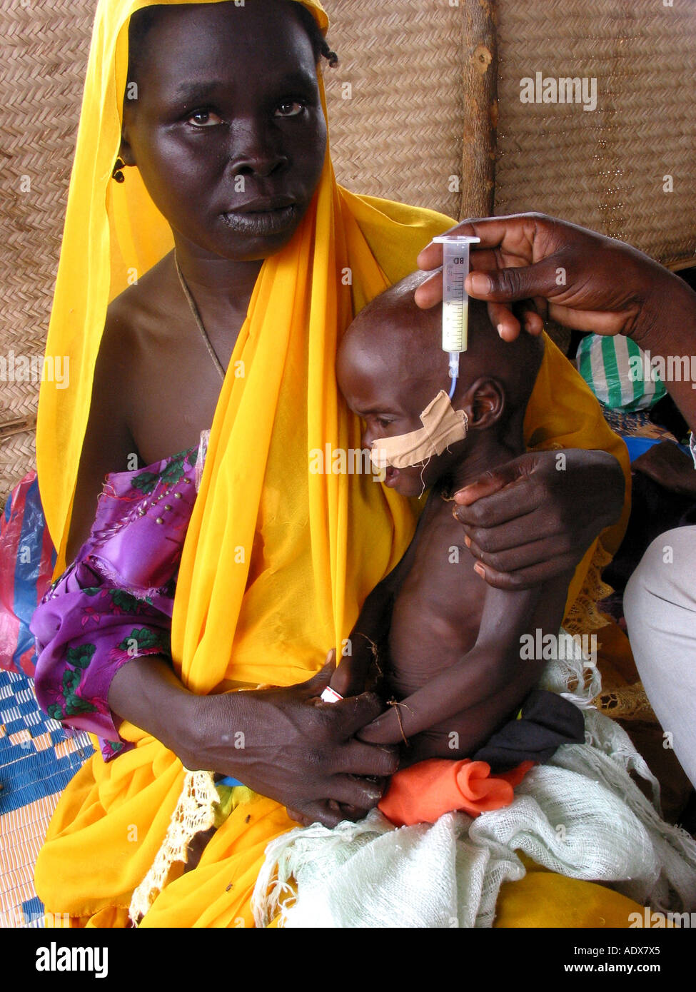L'ouest du Darfour, l'enfant souffrant de malnutrition sévère dans un centre d'alimentation de MSF Banque D'Images