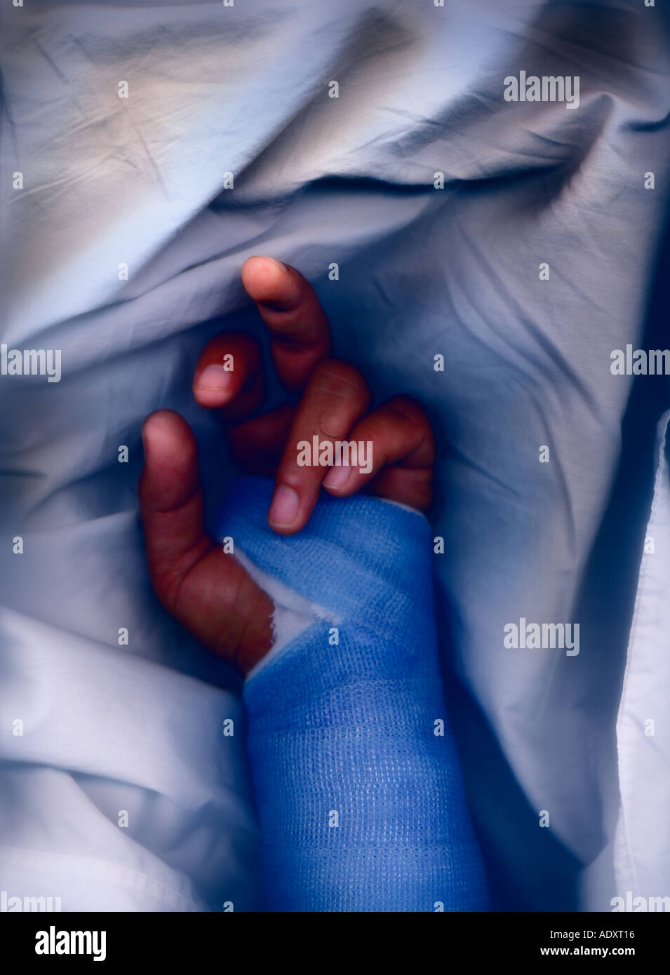 Portrait d'un poignet fracturé dans un plâtre en fibre de verre Photo Stock  - Alamy