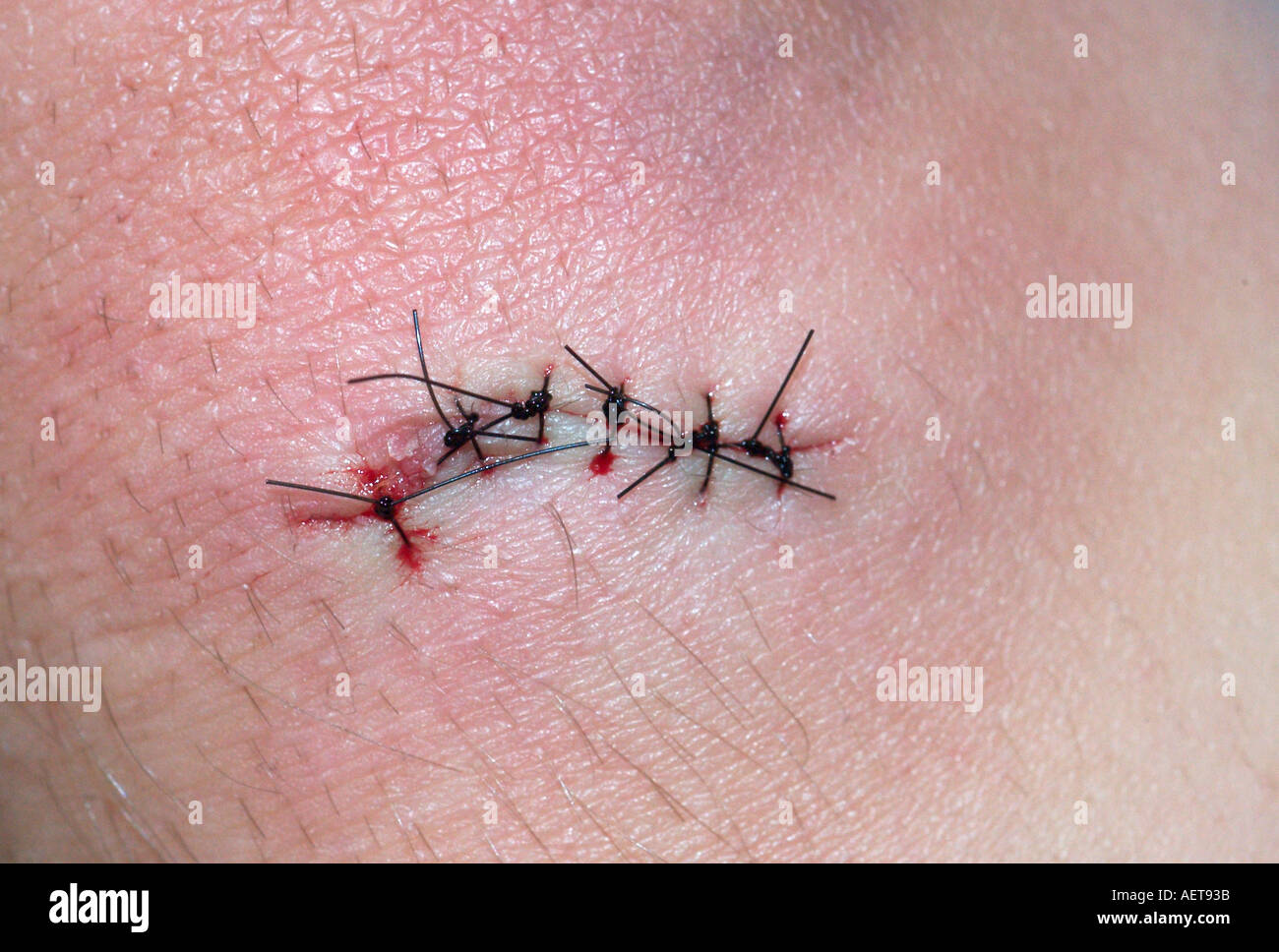 Lacertation de genou fermé avec des sutures Enfant 10 ans Nylon 4 0 technique de suture sutures interrompues Banque D'Images