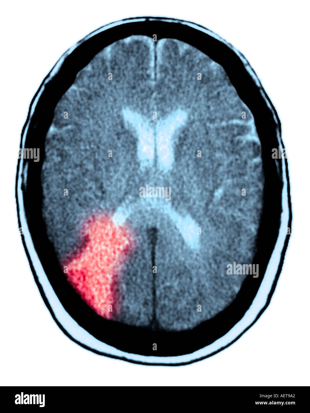 Xray montrant une lésion de la toxoplasmose du cerveau dans un patient immunodéprimés avec le SIDA Banque D'Images
