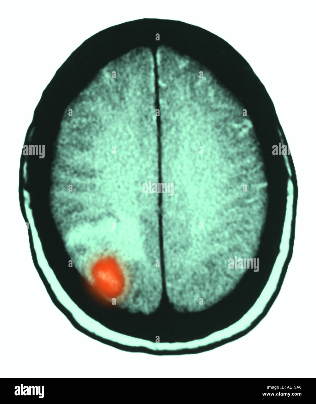 Xray montrant une lésion de la toxoplasmose du cerveau dans un patient immunodéprimés avec le SIDA Banque D'Images