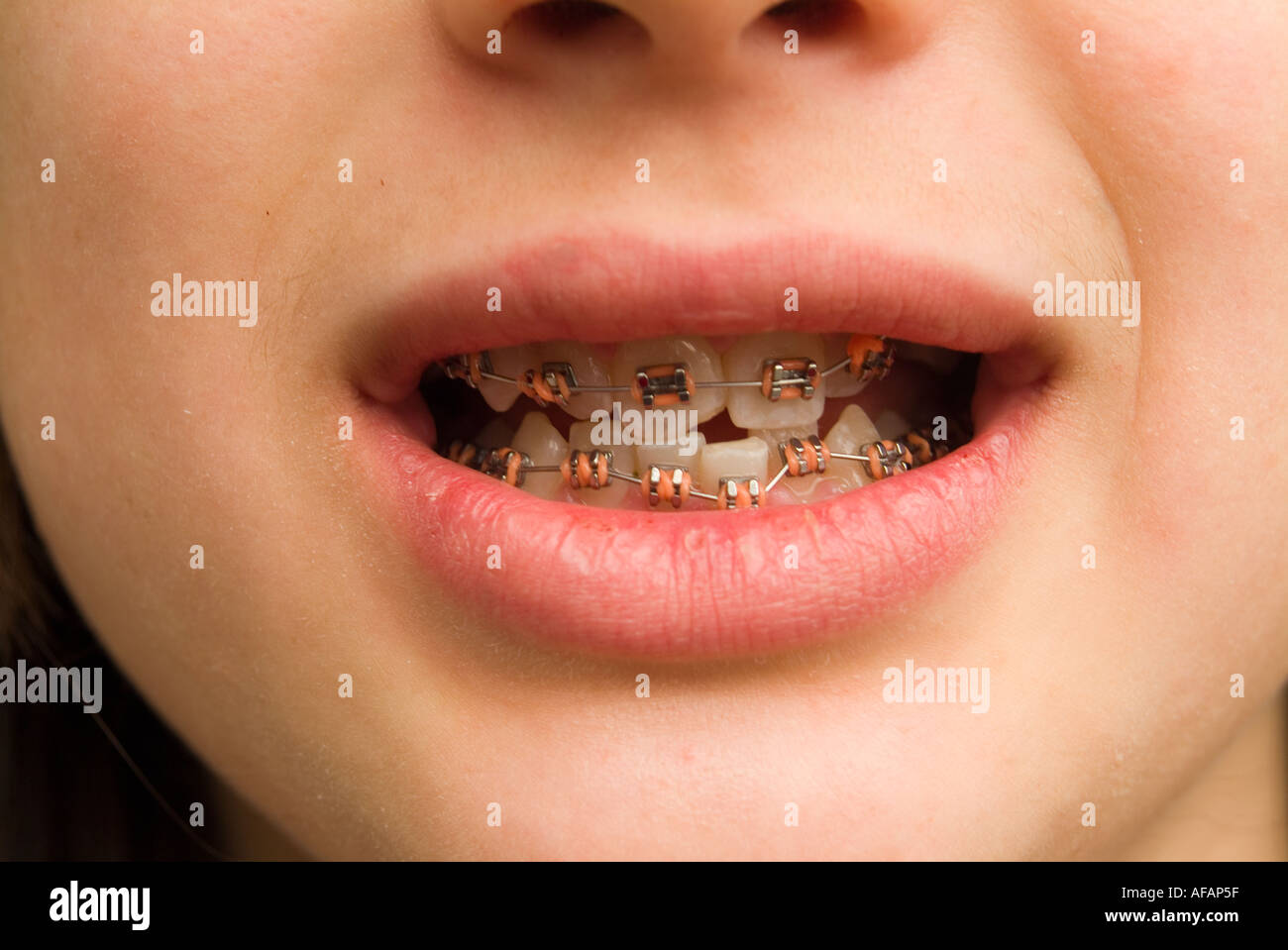 Les appareils dentaires fixés sur les dents des garçons Banque D'Images
