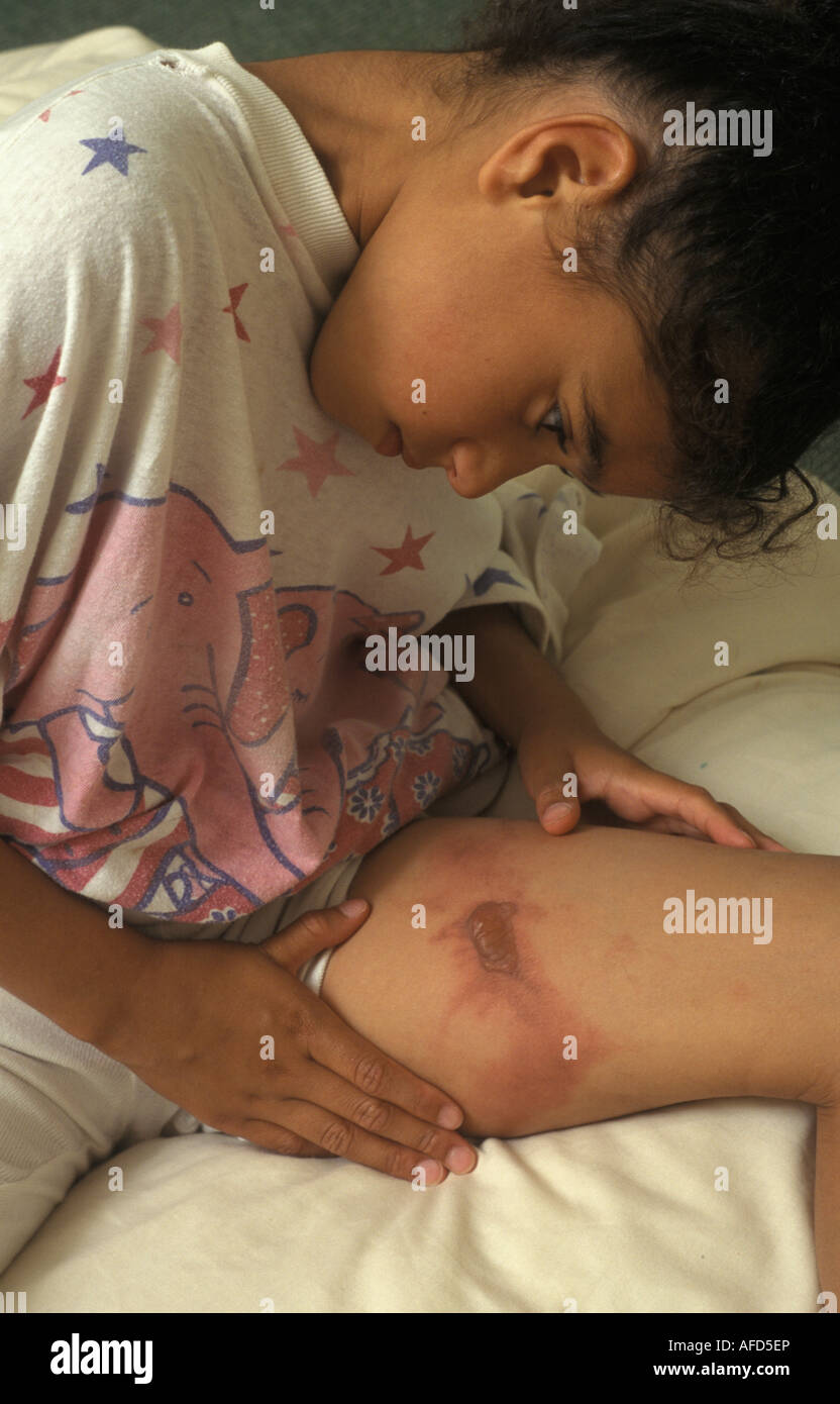 Mixed Race girl examinant une brûlure sur sa jambe Banque D'Images Mixed Race girl examinant une brûlure sur sa jambe Banque D'Images