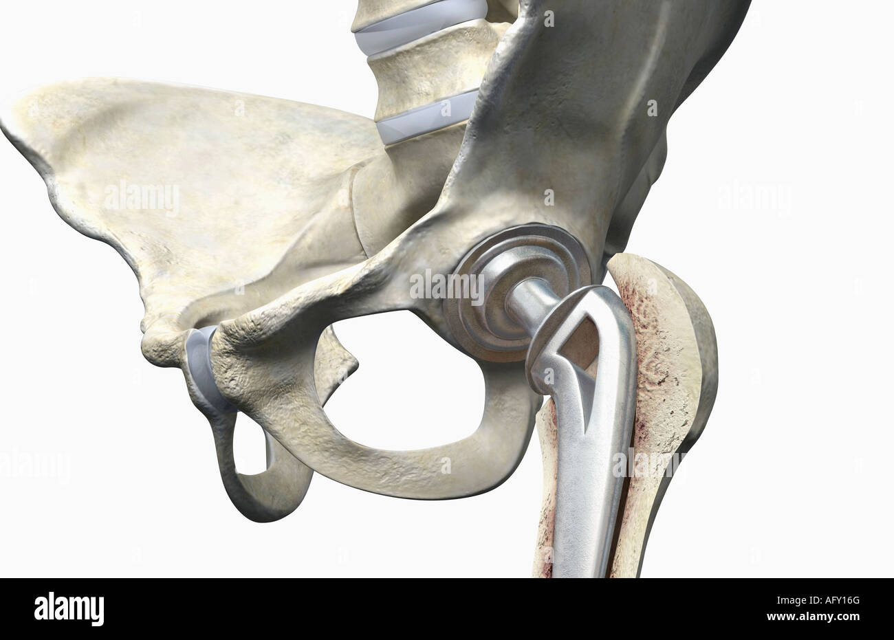 Pièce Médicale Rare : Implant De Hanche En Titane Vinertia, UK