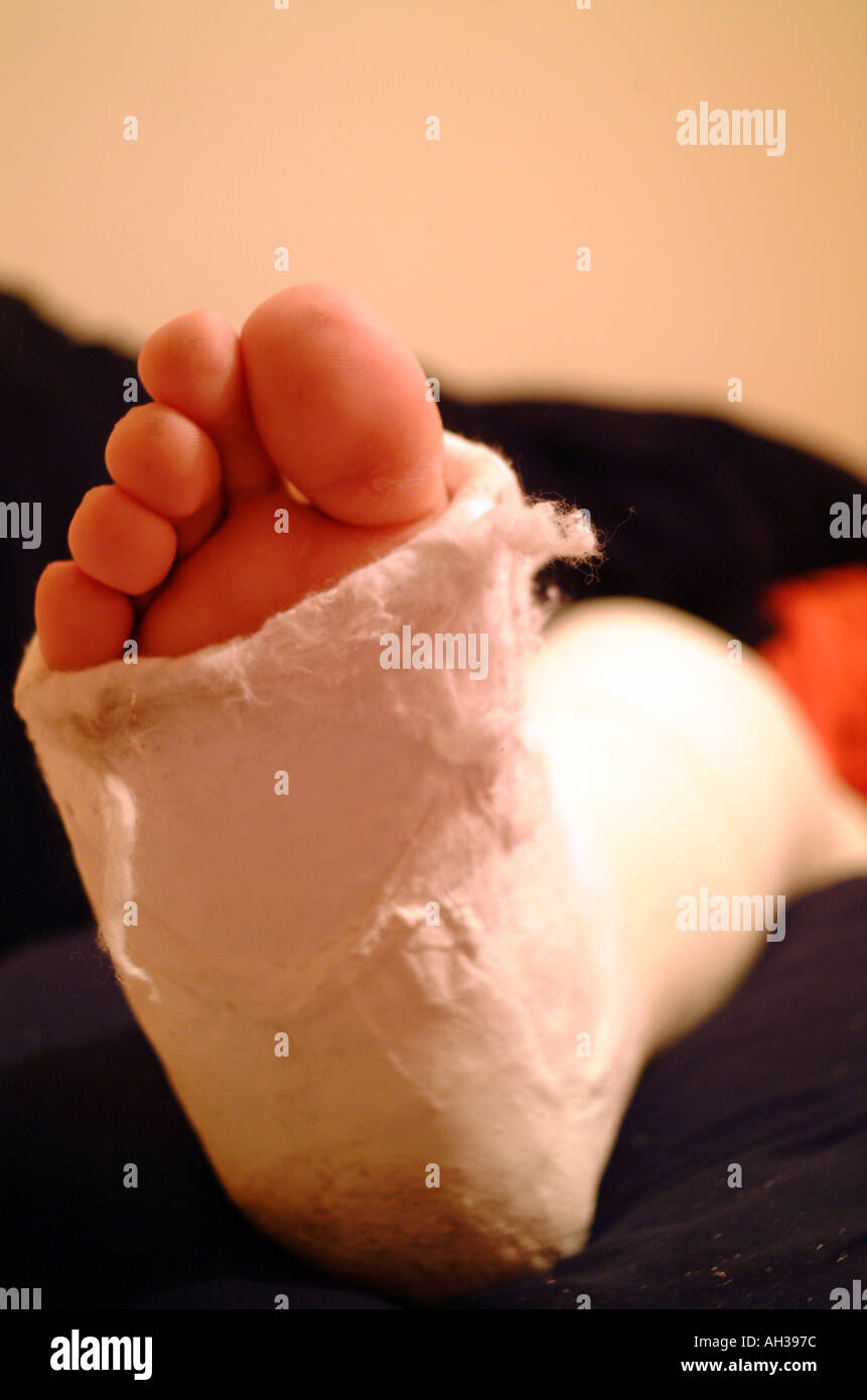 fracture de la jambe Banque D'Images