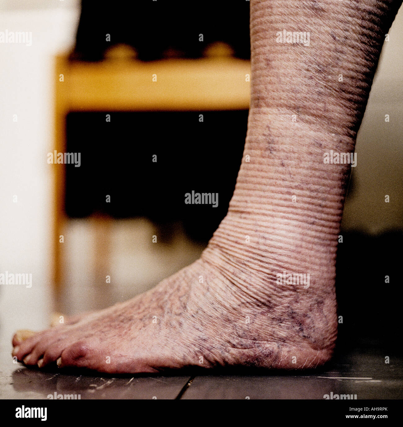 Pied, la jambe et la cheville avec les varices viens et marques de la bas  élastiques Photo Stock - Alamy