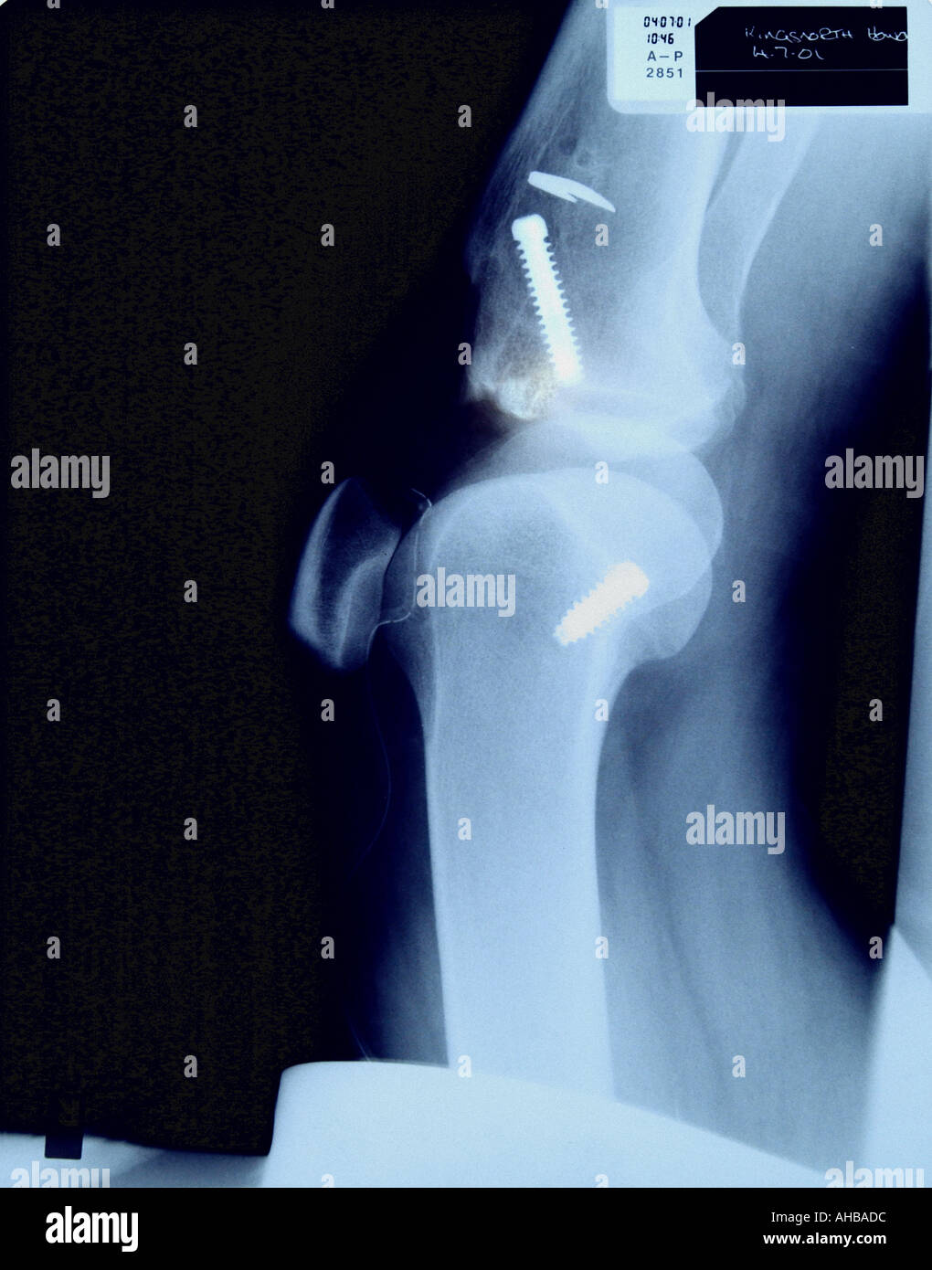 Radiographie d'une articulation du genou avec fixation chirurgicale par vis Banque D'Images